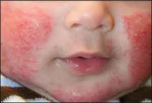 Ozenoxacin Cream, 1%, a Novel Topical Antibiotic for Impetigo approved