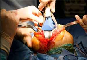 MACI implant regrows Knee Cartilage - Good option for knee transplant