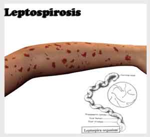 Rare case of Leptospirosis meningitis transmitted by pet mouse