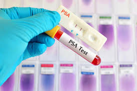 Men between 55 to 69 years allowed to use their discretion for PSA Test : USPTF