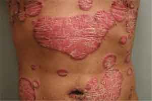 Severe Psoriasis Linked to Increased Risk of Death