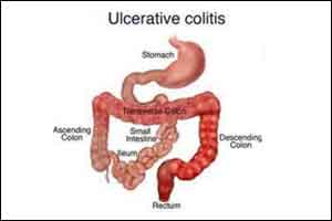 Electronic nose that can distinguish between Crohns disease and ulcerative colitis