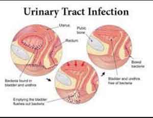 Antimicrobial prescribing in lower Urinary tract infection: NICE Guideline