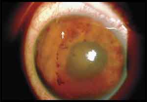 Doctors Find Wriggling Flatworm in Teens Eyeball