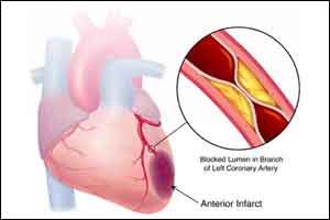Instant blood test for diagnosis of heart attack