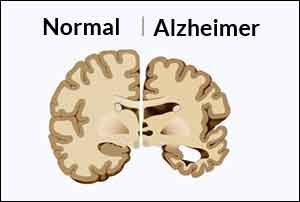 Anxiety: An early indicator of Alzheimers disease?