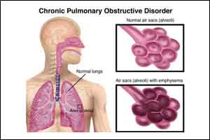 Short term oral steroids for acute exacerbations of COPD