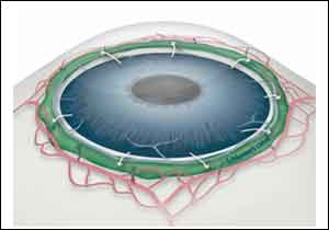 New mechanism of  glaucoma development identified