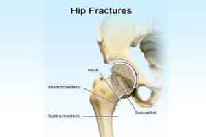 Hip Fractures an early sign of Alzheimer’s in elderly, study suggests