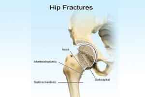 Vitamin B linked to increased hip fracture risk, confirms Norwegian study