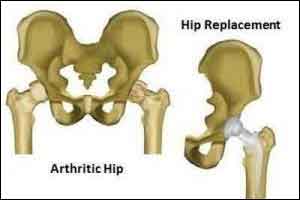 Dual mobility hip replacement  implant has less risk of dislocation : Study