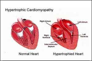 Mavacamten, a promising treatment for Obstructive Hypertrophic Cardiomyopathy