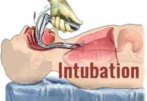 Longer duration of intubation linked to severe laryngeal injury in ICU patients