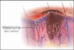 Bariatric surgery associated with 61% reduction in malignant melanoma cases