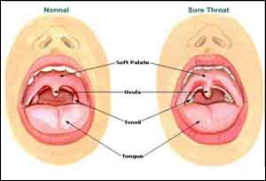 Sore throat, swollen glands linked to thyroid cancer