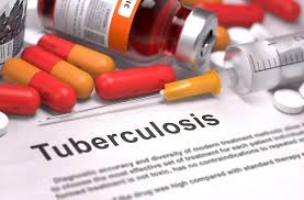 Pulmonary vocal syndrome due to Endobronchial Tuberculosis reported