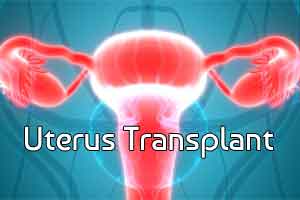 Eight children born after uterus transplants