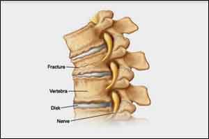 Vertebroplasty ineffective for reducing vertebral fracture pain, Says ASBMR