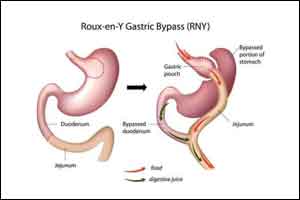 Roux-en-Y Surgery leads to more Fractures than Adjustable Gastric Banding