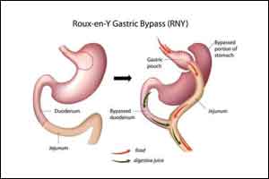 Anemia- a consequence of bariatric surgery