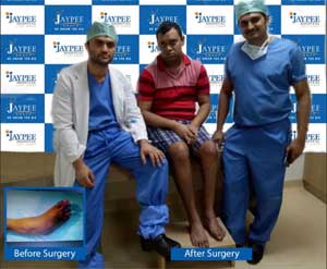 Clubfoot deformity finds cure even  at  age of 25 years