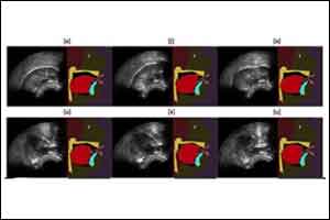 Augmented tongue ultrasound for speech therapy