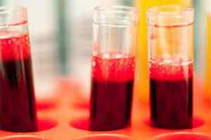 Tropinin Blood test for heart attack diagnosis flawed, finds BMJ Study