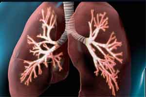 COPD patients on long-term ICS have increased risk of bone fractures