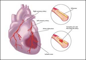 Simultaneous Dual-troponin testing safely rules out MI  very early