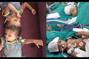 Condition of conjoined twins from Odisha stable: AIIMS doctor