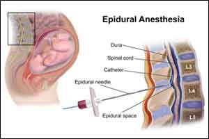Epidural analgesia doesnt slow second stage of labor : Study