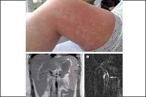 An interesting case of Epstein-Barr virus (EBV) hepatitis