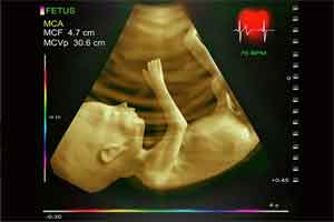 Fetal Echocardiography: Role in ante-natal screening