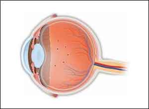 Newer generation Lasers successfully & safely treat floaters in eye
