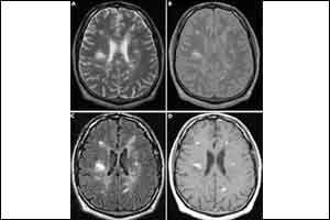 A case of rare encephalitis mimicking psychiatric illness