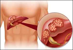 Combining Ultrasound & alpha fetoprotein level improve liver cancer detection by 40 Percent