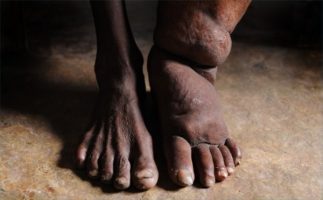 Addition of drug albendazole has no advantages in the treatment of Lymphatic filariasis
