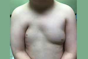 Case presentation of Poland Syndrome in  8-yr-old boy