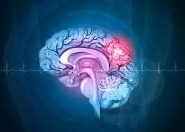 Thrombolysis does not increase risk of bleeding in Stroke patients with dementia
