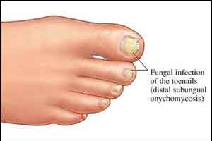 BAD Guidelines for the management of onychomycosis