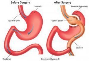 Perform cholecystectomy before gastric bypass surgery to prevent complications