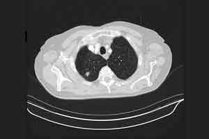 Incidental Pulmonary Nodules Detected on CT Images