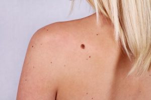Recommendation for Safe and effective margin for skin removal around suspicious moles