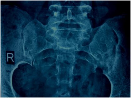 A case of reported Sacroilitis finally diagnosed by Ultrasound Evaluation