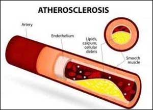 Anti-inflammatory drugs not yet for Atherosclerosis-ESC Consensus statement