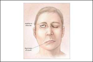 AAO-HNSF Clinical Practice Guidelines on Bells Palsy