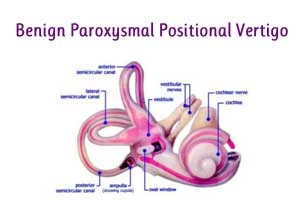 Clinical Practice Guideline: Benign Paroxysmal Positional Vertigo