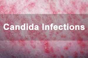 First Quick Test for Diagnosing Candidiasis without Blood Culture