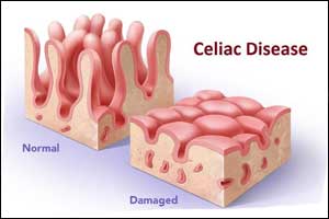 Celiac Disease diagnosis takes 3.5 years in patients who have no GI Symptoms : JAMA