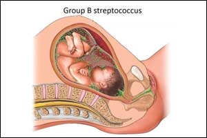 Group B Streptococcus infection causes estimated 150,000 stillbirth & infant death